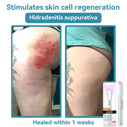 ✨QIAWI™ All-in-One CO₂ Laser Eraser Pen | Removes Moles, Warts, Skin Flaws & Pigmentation（副本）